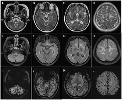 Case Report: Diffuse Cerebral Microbleeds in Cerebral Autosomal Recessive Arteriopathy With Subcortical Infarcts and Leukoencephalopathy